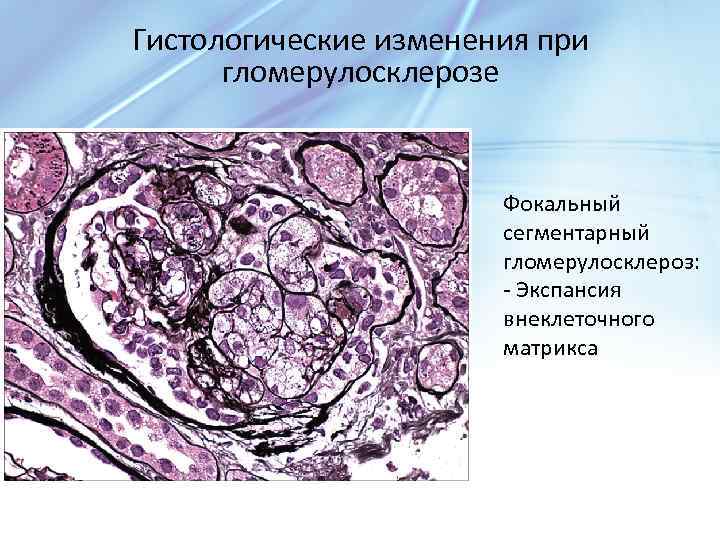 Гистологические изменения при гломерулосклерозе Фокальный сегментарный гломерулосклероз: - Экспансия внеклеточного матрикса 