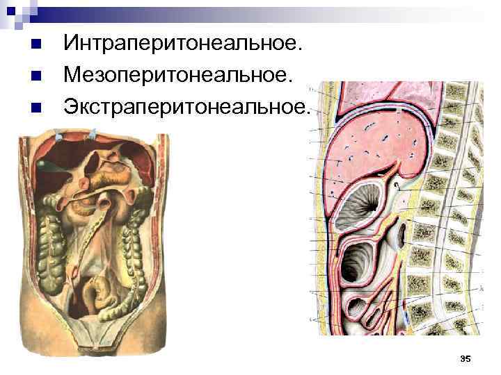 n n n Интраперитонеальное. Мезоперитонеальное. Экстраперитонеальное. 35 