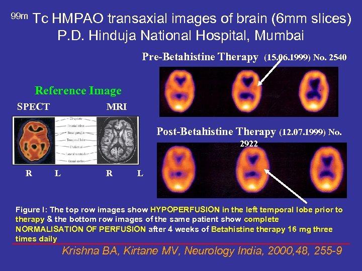 99 m Tc HMPAO transaxial images of brain (6 mm slices) P. D. Hinduja