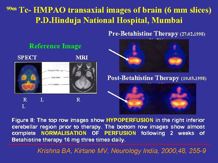 99 m Tc- HMPAO transaxial images of brain (6 mm slices) P. D. Hinduja