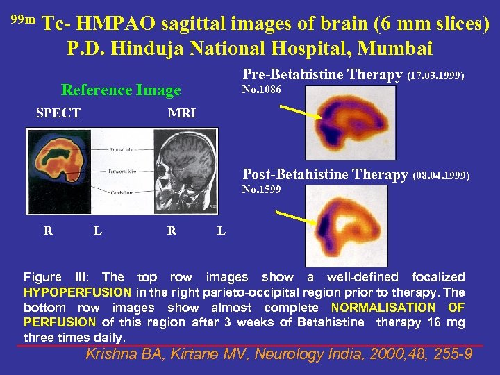 99 m Tc- HMPAO sagittal images of brain (6 mm slices) P. D. Hinduja