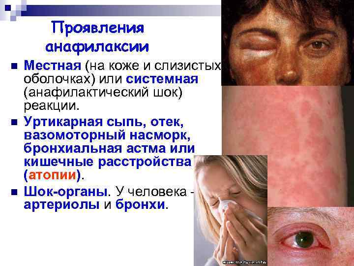 Проявления анафилаксии n n n Местная (на коже и слизистых оболочках) или системная (анафилактический