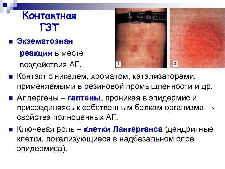 Контактная ГЗТ n n Экзематозная реакция в месте воздействия АГ. Контакт с никелем, хроматом,