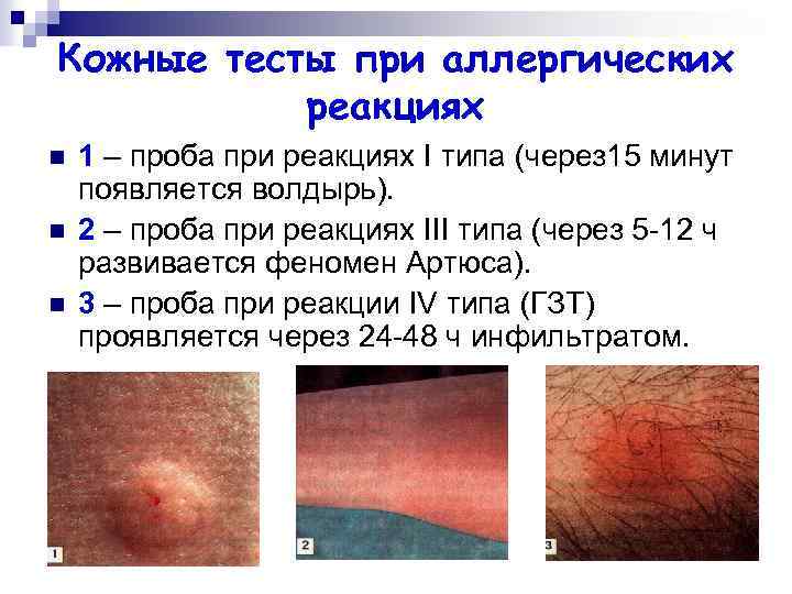 Кожные тесты при аллергических реакциях n n n 1 – проба при реакциях I