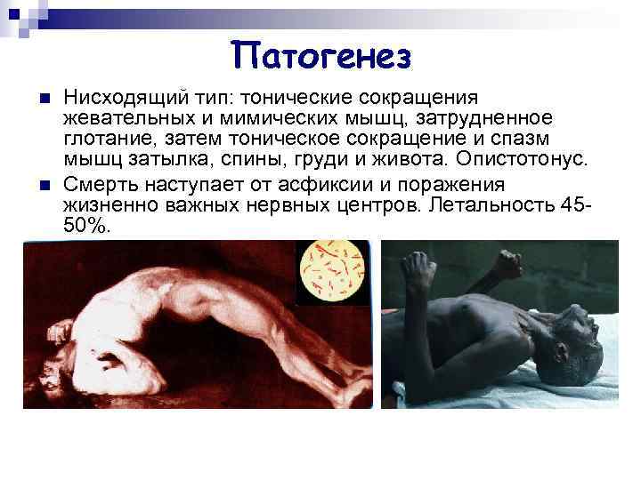 Патогенез n n Нисходящий тип: тонические сокращения жевательных и мимических мышц, затрудненное глотание, затем