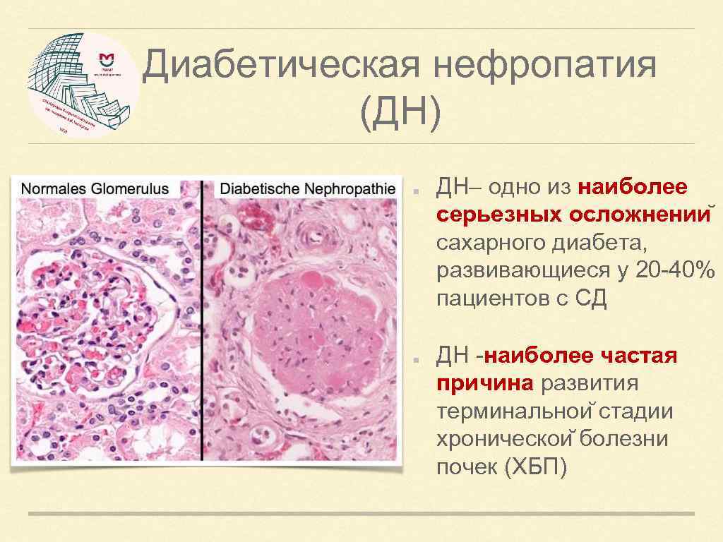 Почечный диабет. Диабетическая нефропатия осложнения. Диабетическая нефропатия клинические рекомендации 2020. Диабетическая уратная нефропатия. Исход диабетической нефропатии.