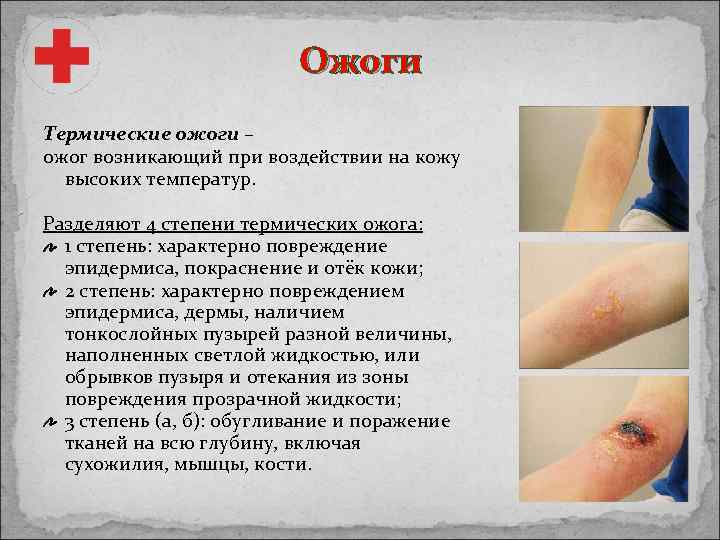 Ожоги Термические ожоги – ожог возникающий при воздействии на кожу высоких температур. Разделяют 4