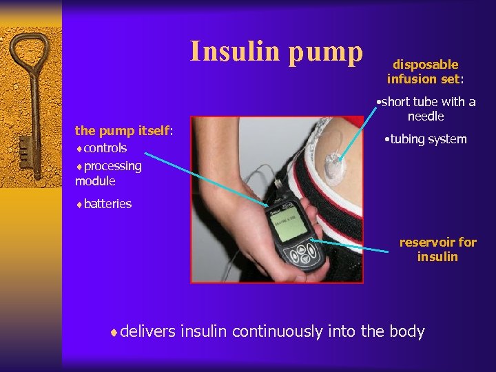 Insulin pump the pump itself: ¨controls ¨processing module disposable infusion set: • short tube