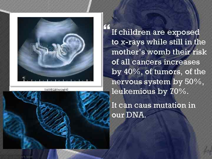  If children are exposed to x-rays while still in the mother’s womb their