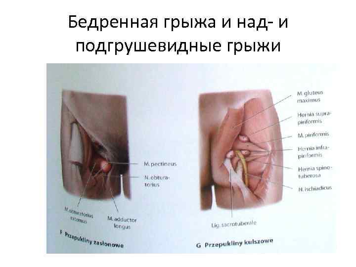 Бедренная грыжа и над- и подгрушевидные грыжи 