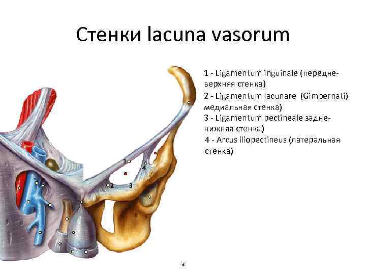 Стенки lacuna vasorum 1 - Ligamentum inguinale (передневерхняя стенка) 2 - Ligamentum lacunare (Gimbernati)