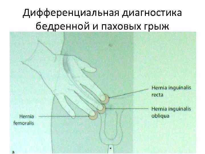 Дифференциальная диагностика бедренной и паховых грыж * 