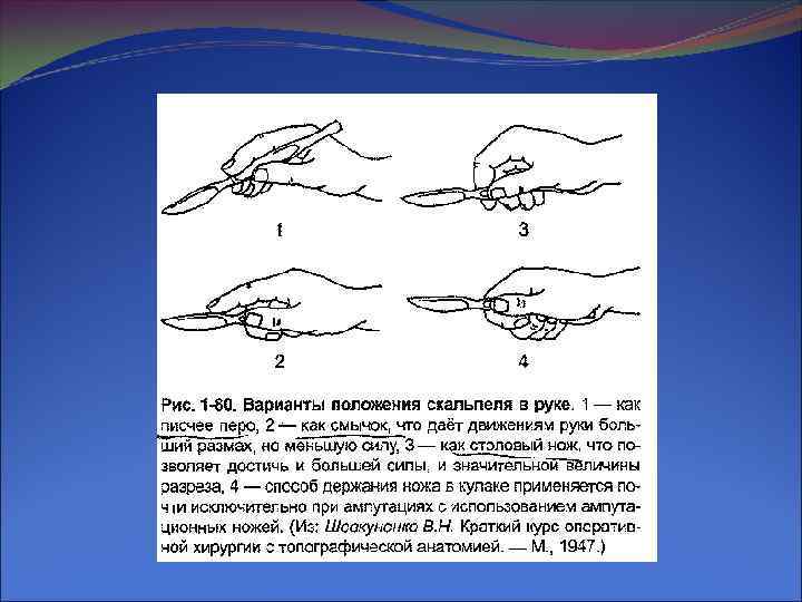 Техника операций. Позиции держания скальпеля. Способы держания скальпеля. Основные позиции скальпеля. Позиции держания скальпеля в руке.