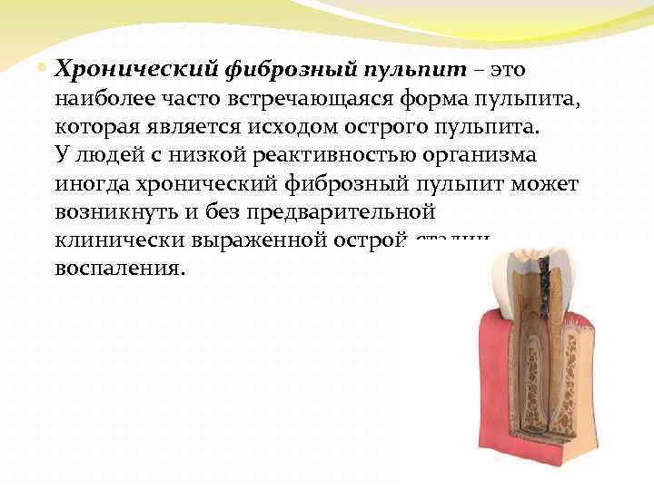  Хронический фиброзный пульпит – это наиболее часто встречающаяся форма пульпита, которая является исходом