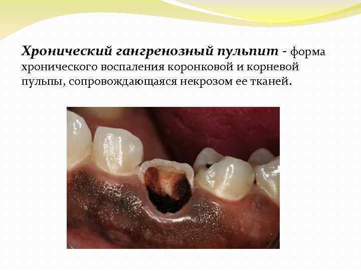 Хронический гангренозный пульпит - форма хронического воспаления коронковой и корневой пульпы, сопровождающаяся некрозом ее