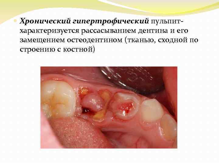  Хронический гипертрофический пульпитхарактеризуется рассасыванием дентина и его замещением остеодентином (тканью, сходной по строению