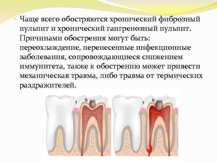  Чаще всего обостряются хронический фиброзный пульпит и хронический гангренозный пульпит. Причинами обострения могут