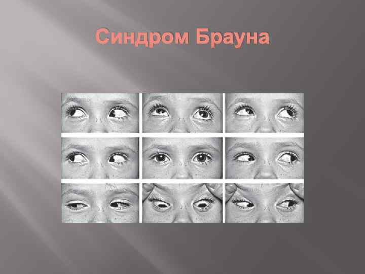 Синдром Брауна 