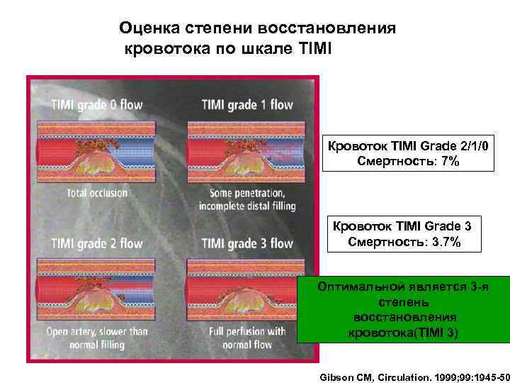 Степень восстановления. Timi классификация кровотока. Классификация коронарного кровотока по Timi. Шкала Timi оценка коронарного кровотока. Коронарный кровоток Timi.