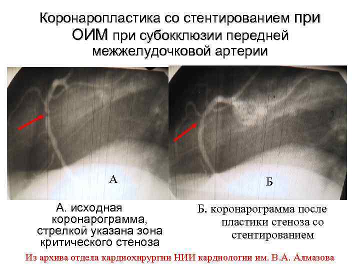 Коронаропластика со стентированием при ОИМ при субокклюзии передней межжелудочковой артерии А А. исходная коронарограмма,