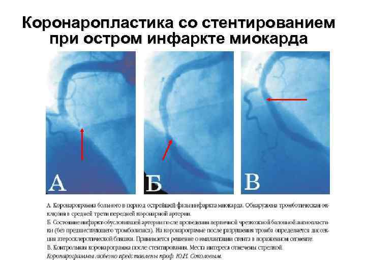 Коронаропластика со стентированием при остром инфаркте миокарда 