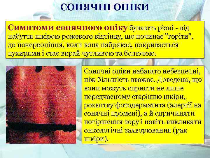 СОНЯЧНІ ОПІКИ Симптоми сонячного опіку бувають різні - від набуття шкірою рожевого відтінку, що