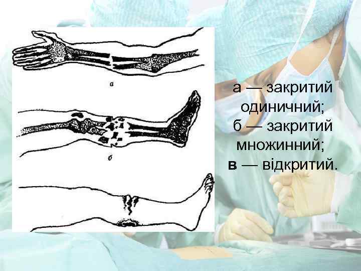 а — закритий одиничний; б — закритий множинний; в — відкритий. 