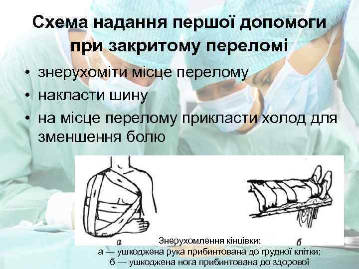 Схема надання першої допомоги при закритому переломі • знерухоміти місце перелому • накласти шину