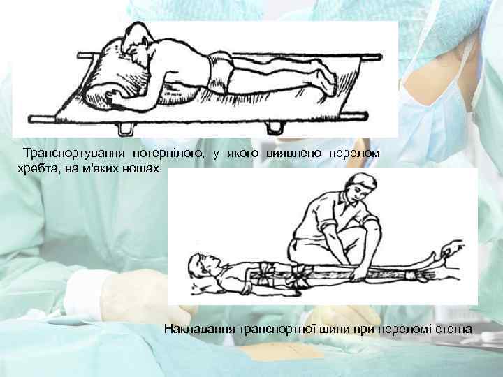 Транспортування потерпілого, у якого виявлено перелом хребта, на м'яких ношах Накладання транспортної шини при