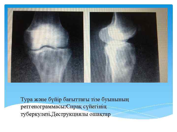 Тура және бүйір бағыттағы тізе буынының ретгенограммасы: Сирақ сүйегінің туберкулезі. Деструкциялы ошақтар. 