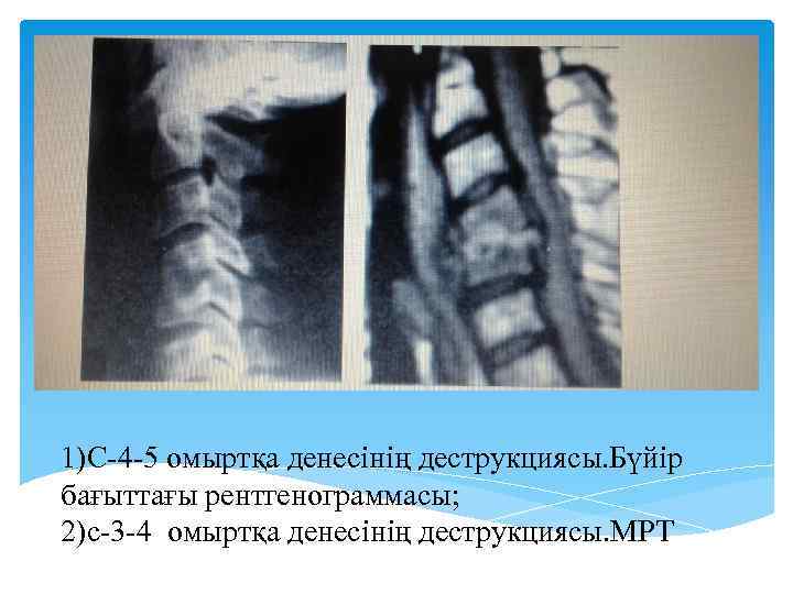 1)С-4 -5 омыртқа денесінің деструкциясы. Бүйір бағыттағы рентгенограммасы; 2)с-3 -4 омыртқа денесінің деструкциясы. МРТ