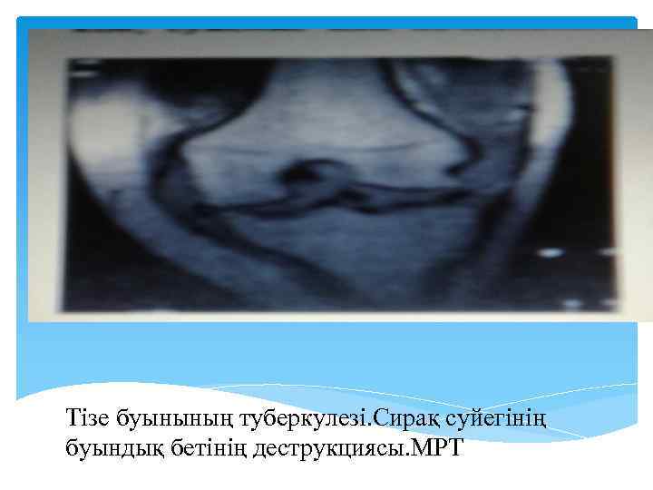 Тізе буынының туберкулезі. Сирақ суйегінің буындық бетінің деструкциясы. МРТ 