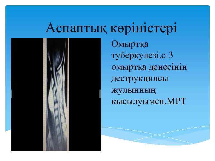 Аспаптық көріністері Омыртқа туберкулезі. с-3 омыртқа денесінің деструкциясы жулынның қысылуымен. МРТ 