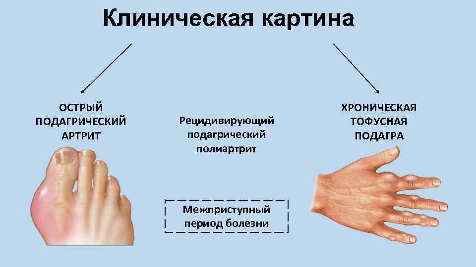 Клиническая картина ОСТРЫЙ ПОДАГРИЧЕСКИЙ АРТРИТ Рецидивирующий подагрический полиартрит Межприступный период болезни ХРОНИЧЕСКАЯ ТОФУСНАЯ ПОДАГРА