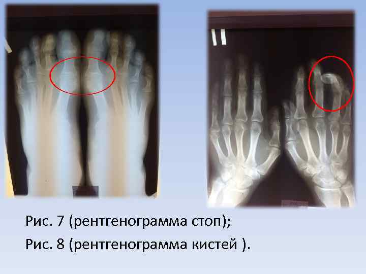 Рис. 7 (рентгенограмма стоп); Рис. 8 (рентгенограмма кистей ). 