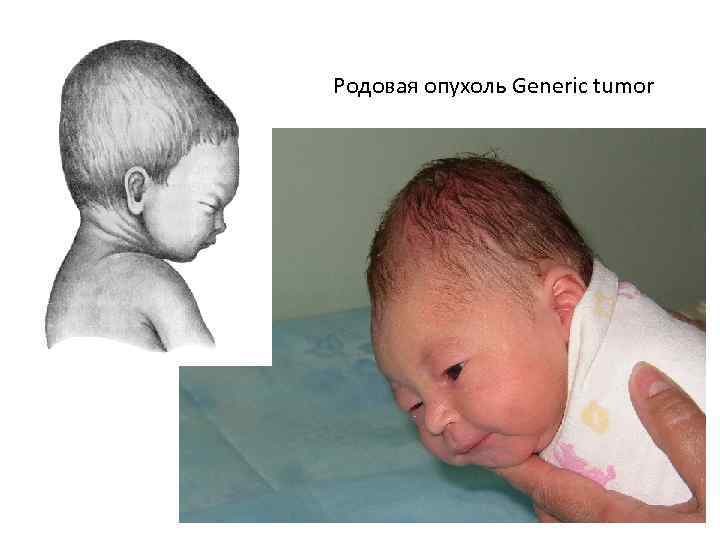 Родовая опухоль Generic tumor 