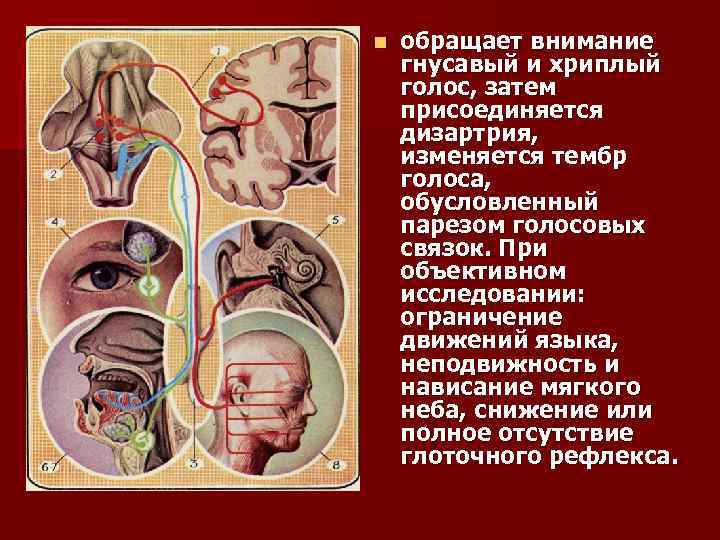 n обращает внимание гнусавый и хриплый голос, затем присоединяется дизартрия, изменяется тембр голоса, обусловленный