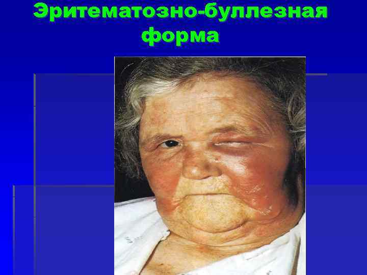 Эритематозно-буллезная форма 