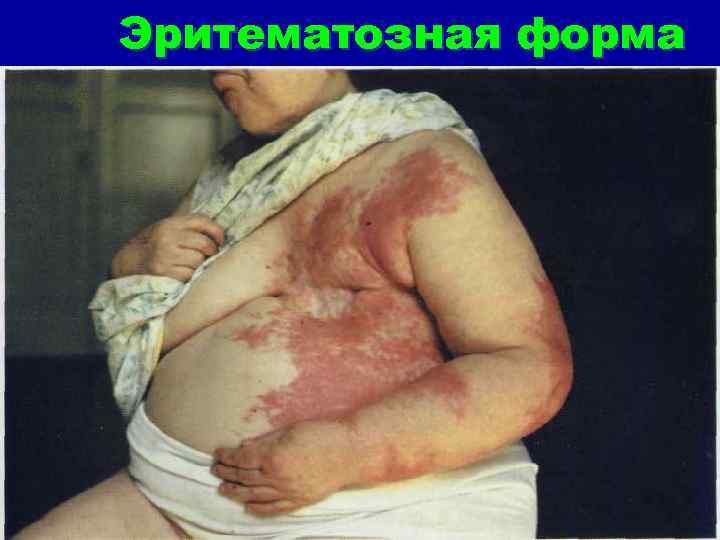 Эритематозная форма 
