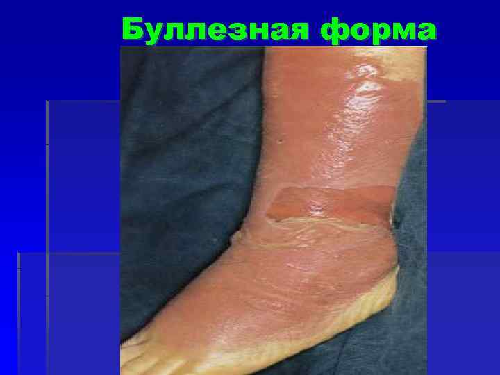 Буллезная форма 