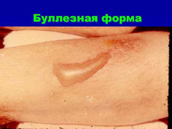 Буллезная форма 