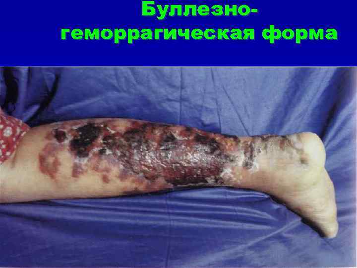 Буллезногеморрагическая форма 