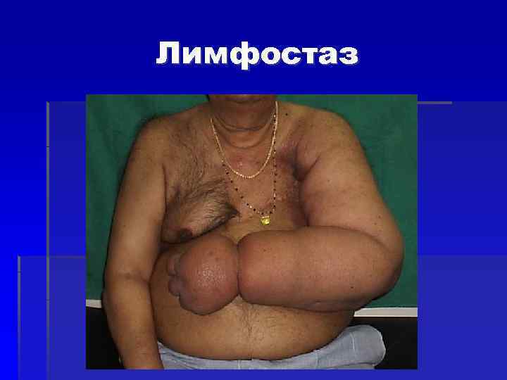 Лимфостаз 