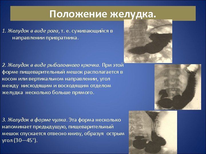 Положение желудка. 1. Желудок в виде рога, т. е. суживающийся в направлении привратника. 2.