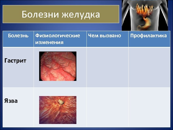 Болезни желудка Болезнь Гастрит Язва Физиологические изменения Чем вызвано Профилактика 