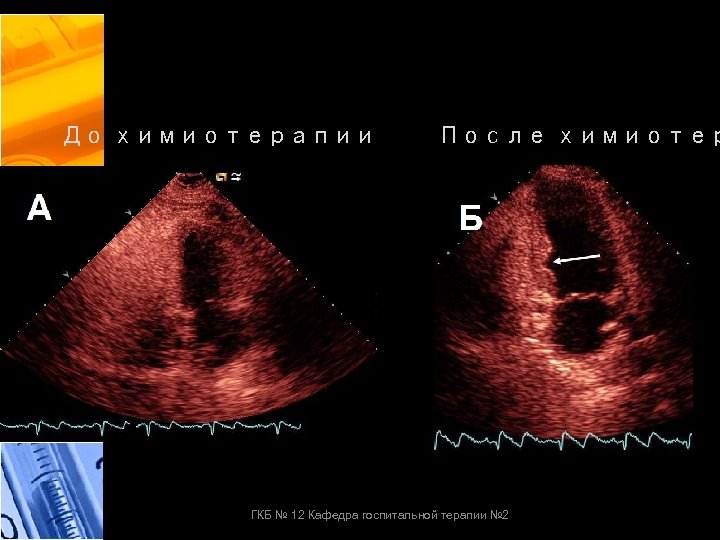 До химиотерапии После химиотер ГКБ № 12 Кафедра госпитальной терапии № 2 
