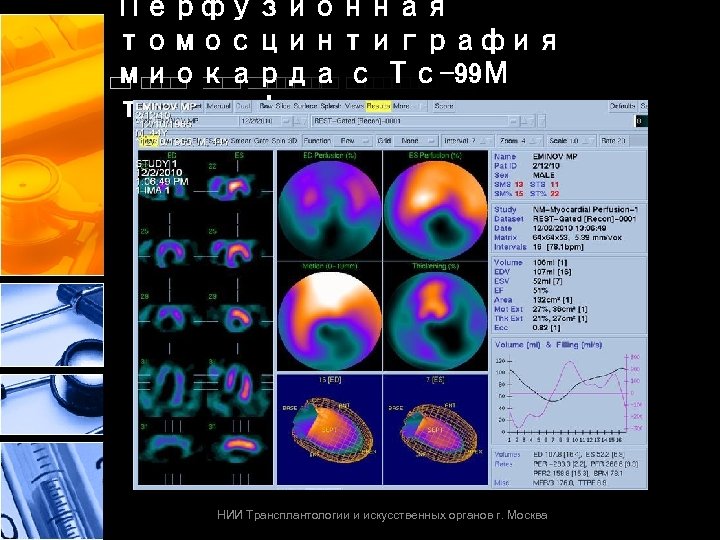 Перфузионная томосцинтиграфия миокарда с Тс-99 М тетрофосмином НИИ Трансплантологии и искусственных органов г. Москва