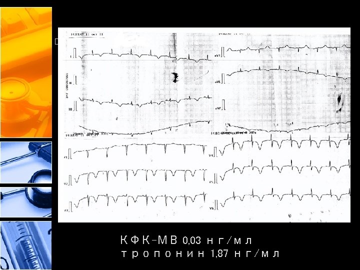 КФК-МВ 0, 03 нг/мл тропонин 1, 87 нг/мл 
