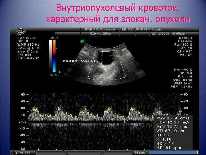 Внутриопухолевый кровоток, характерный для злокач. опухоли 