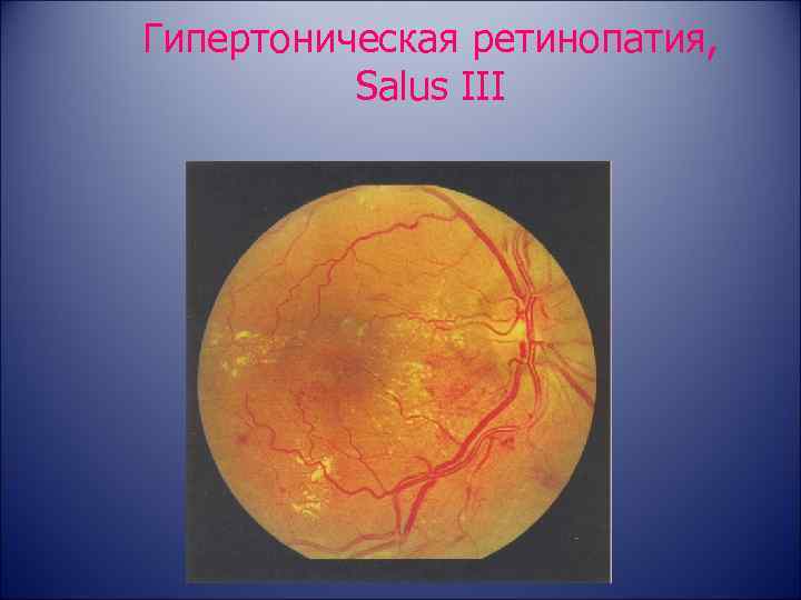 Гипертоническая ретинопатия, Salus III 